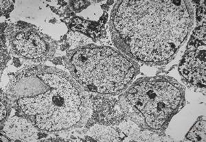 F, 85y. | Merkel cell tumor F, 85y. | Merkel cell tumor